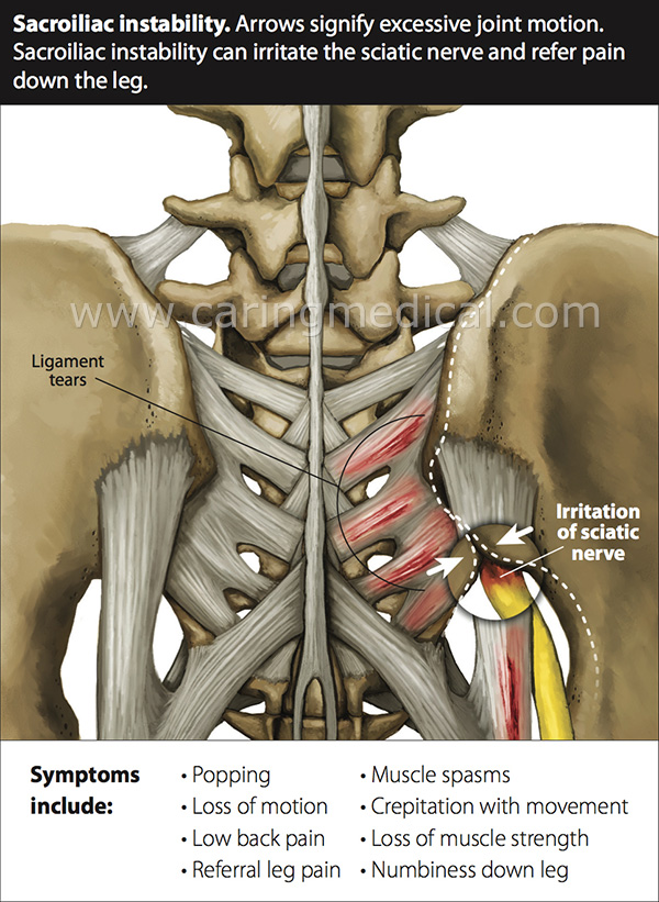 Relieving Pinched and Compressed Nerves - The Hauser Diet