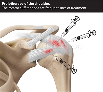 Shoulder Pain Treatments - Protherapy Clinic